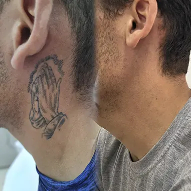 Remoção de tatuagem a laser, antes e depois